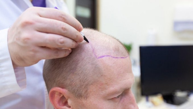 Diyanet’ten ‘saç ektirme’ ve ‘peruk’ fetvası