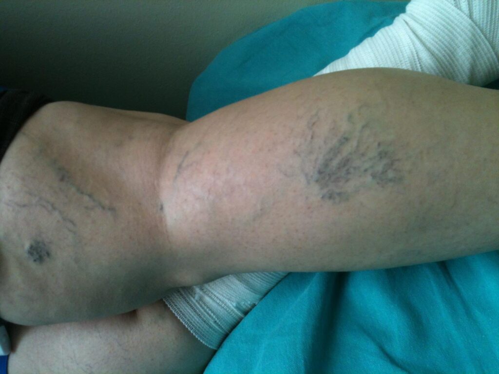 Sıcak havalarda varise dikkat!