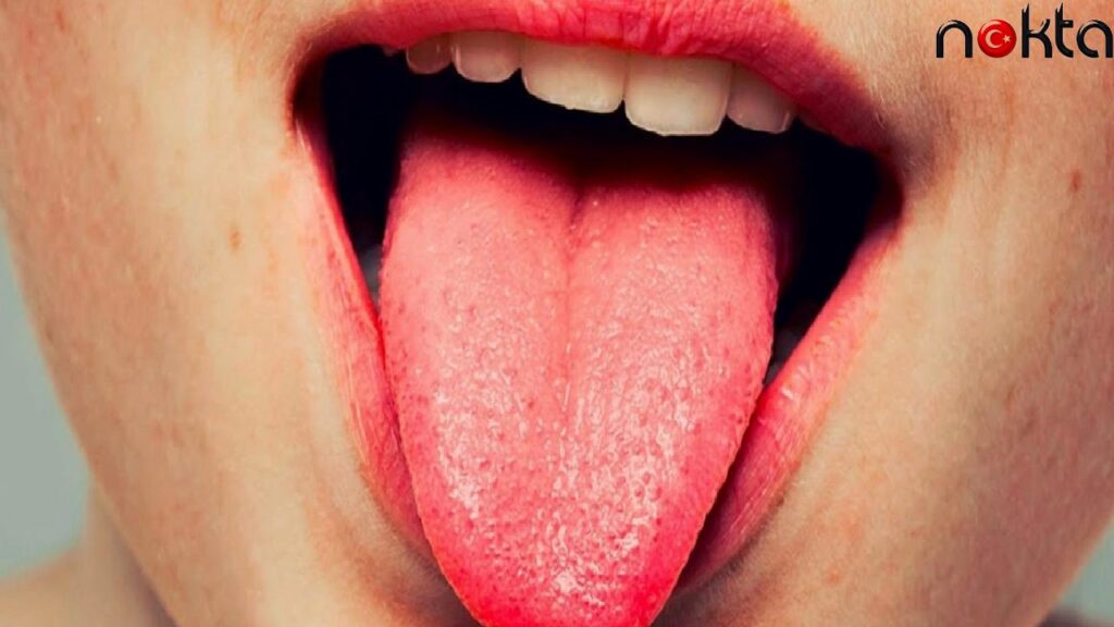 Dil üstü sarılık nasıl temizlenir?