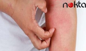 Pandemi vatandaşı “uyuz” etti: Koronavirüs sonrası uyuz vakaları arttı