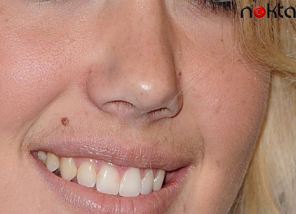 Kadınlarda Bıyık Çıkmasını Önlemenin Yolları Neler?