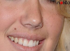 Kadınlarda Bıyık Çıkmasını Önlemenin Yolları Neler?