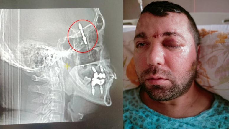 Bursa’da diş implantı yaptırdı, hayatının şokunu yaşadı