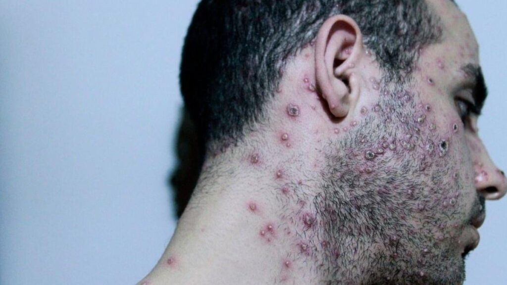 M çiçeği kabusu: Avrupa da alarmda