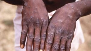 M çiçeği virüsü yayılıyor! DSÖ’den dikkat çeken uyarılar