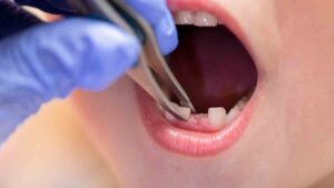 Diş hekimi süt dişlerin neden çekilmemesi gerektiğini açıkladı ve uyardı!