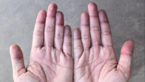 Ellerinize dikkat edin! Hastalıkların ilk belirtisi tırnaklarda görülüyor…