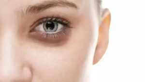 GÖZ ÇEVRESİNDE YAŞLANMANIN ÖNLENMESİ İÇİN NELER YAPILABİLİR?