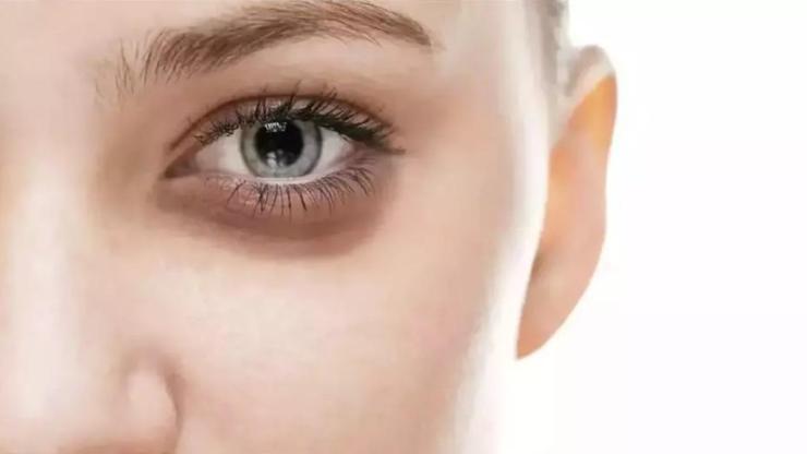 GÖZ ÇEVRESİNDE YAŞLANMANIN ÖNLENMESİ İÇİN NELER YAPILABİLİR?