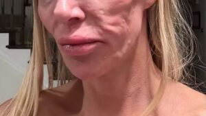 Ünlü oyuncunun yüzünü parazitler sardı! Aynada kendini tanıyamıyor