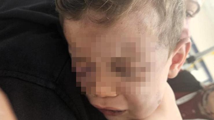 Denizli’de 2 yaşındaki bebek darp edildi! Hayati tehlikesi devam ediyor…