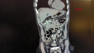 Midesinde paket paket uyuşturucu taşıdı